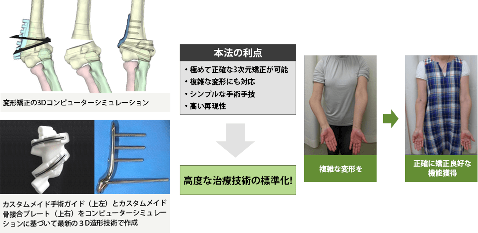 カスタムメイド手術ガイド及びカスタムメイド骨接合プレー