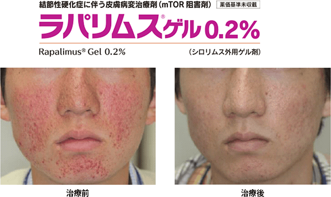 2018年　結節性硬化症に対するシロリムスゲル(0.2％)