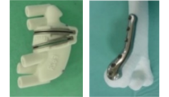 アキュリオ変形矯正システム